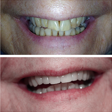 Smile Makeover Patient 11