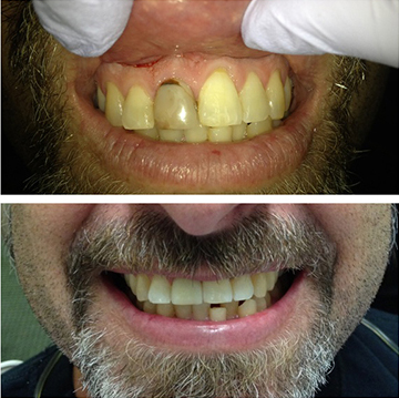 Smile Makeover Patient