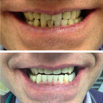 Tooth Restoration patient