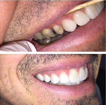 Smile Makeover Patient