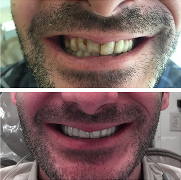 Tooth Restoration Patient