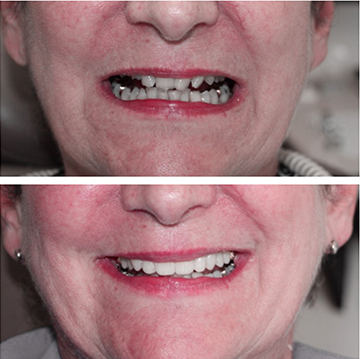 Dental Implants Patient 9